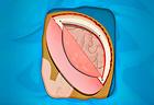Operate Now: Epilepsy Surgery