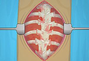 Operate Now: Scoliosis Surgery